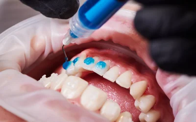 How Much Does Teeth Whitening Cost?