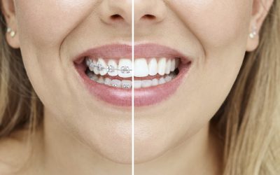 Invisalign vs. Braces: Which Is Right for You?