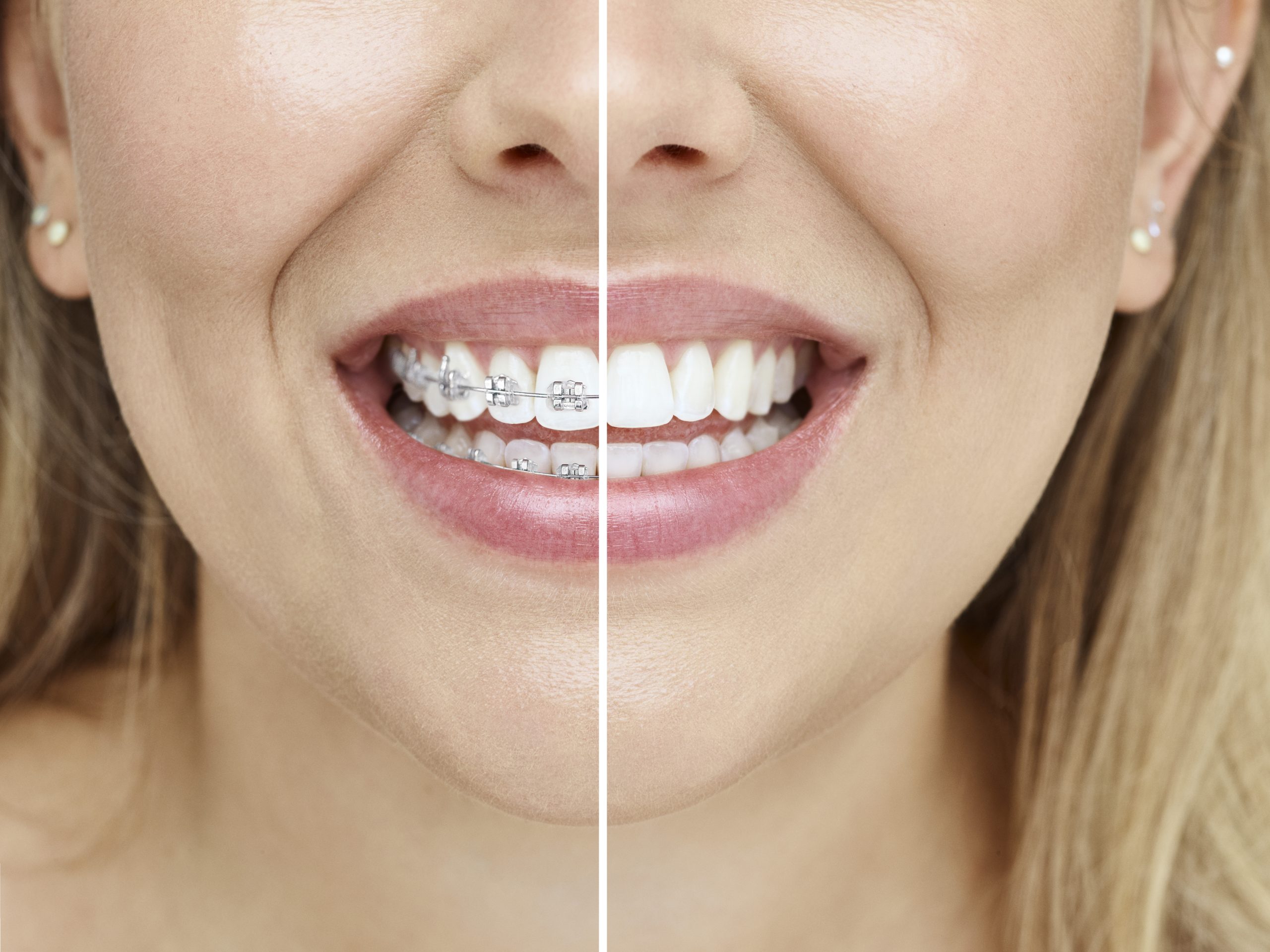 invisalign vs braces